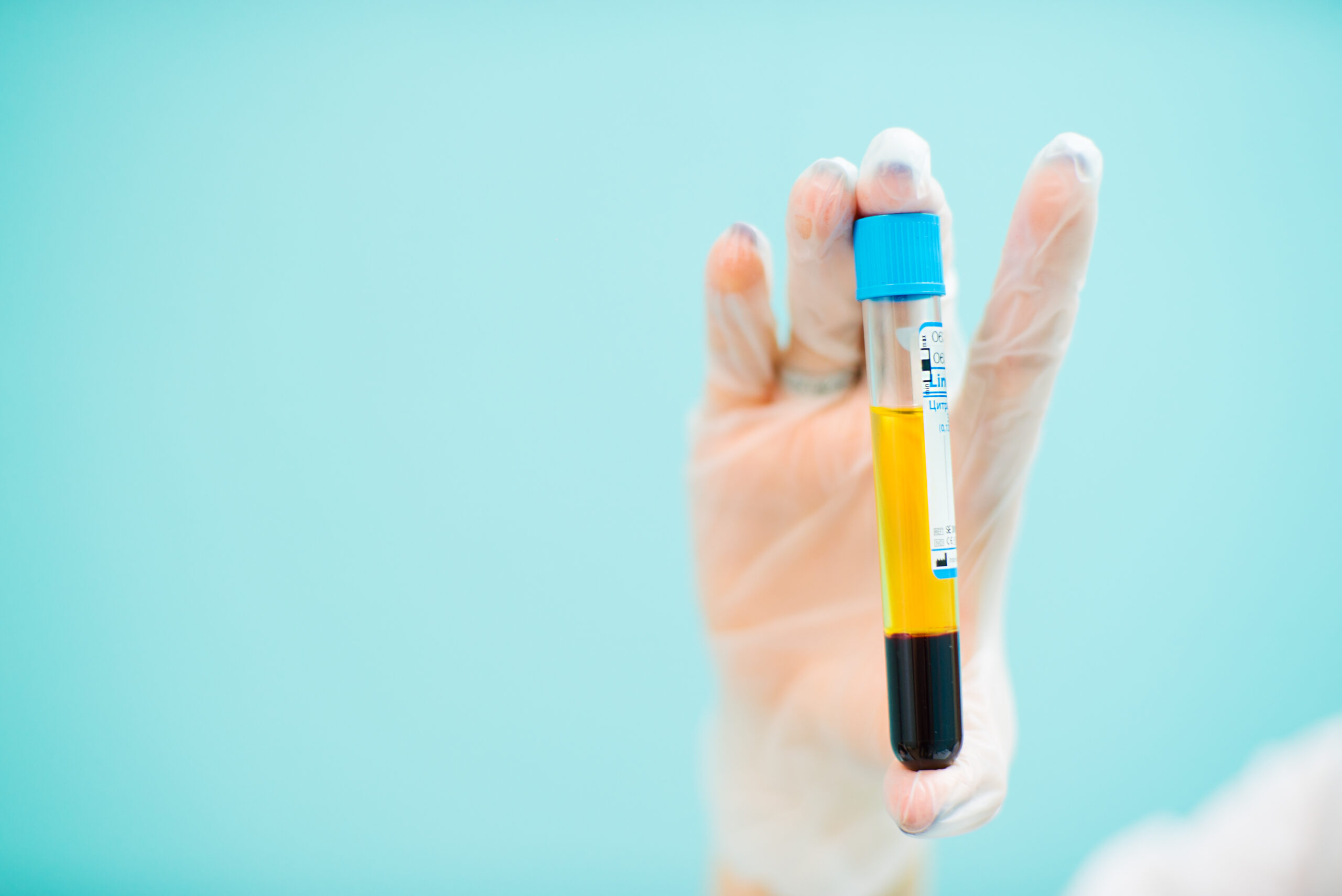 Medical cosmetology blood plasma in vitro keeps the doctor